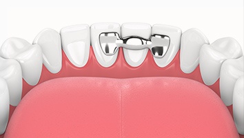 animation of teeth with fixed retainer