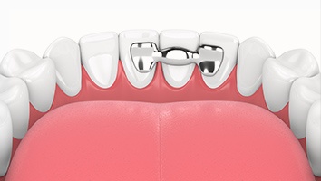 animation of teeth with fixed retainer