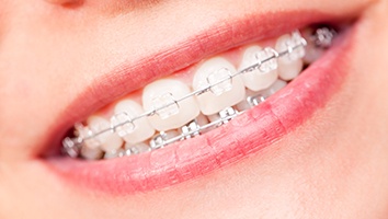 Closeup of teeth with clear bracket and wire braces