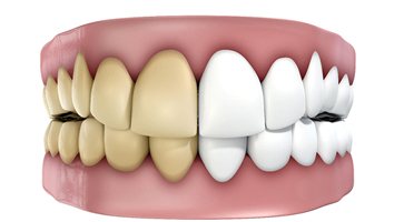 Discolored teeth