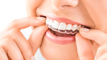 Close up of woman using Invisalign clear aligner