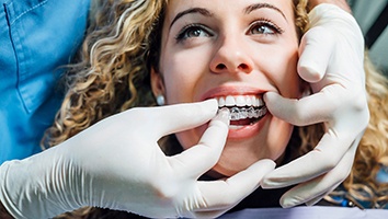 dentist putting Invisalign in mouth 