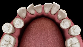 3D graphic of crowded teeth 