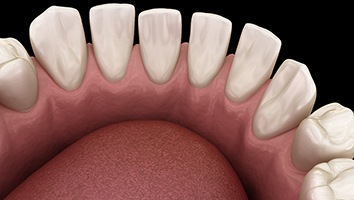 3D graphic of gaps between teeth