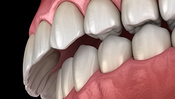 3D graphic of overbite 