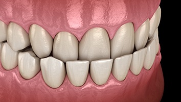 3D graphic of underbite