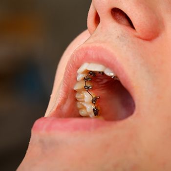 Person wearing lingual braces opening their mouth