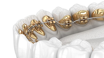 Diagram highlighting lingual braces