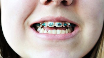 Child’s smile with crooked teeth on bottom and braces on top