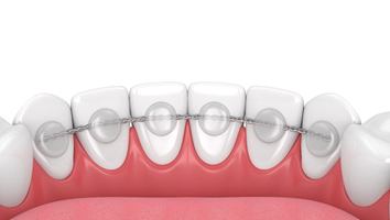 Illustration of fixed retainer in Webster