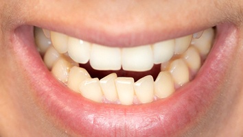 Closeup of patient with crooked teeth smiling