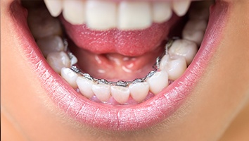 Closeup of smile with lingual braces