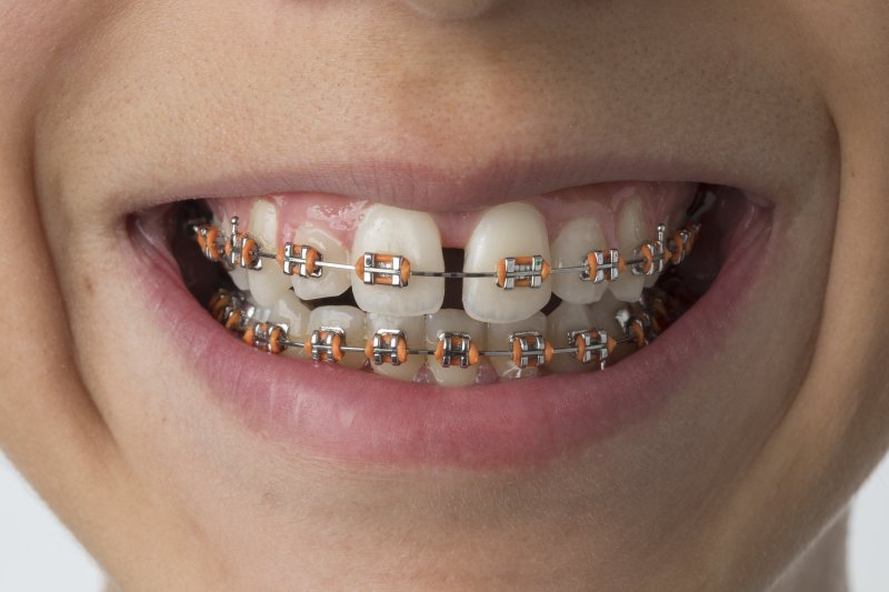 Close-up of mouth and teeth with dental braces