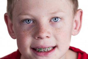 Boy smiling with braces from orthodontist in Rochester 