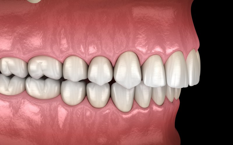 Illustration of an overbite with teeth and gums visible