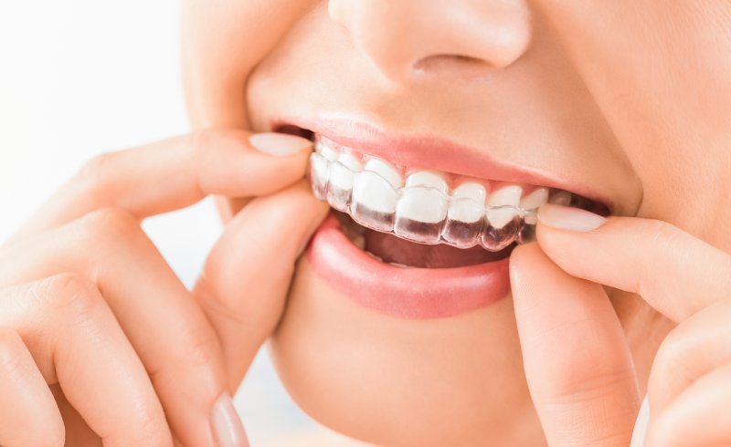 Woman putting clear aligner on top row of smile